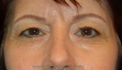 Blepharoplasty Before & After Gallery - Patient 236842 - Image 1