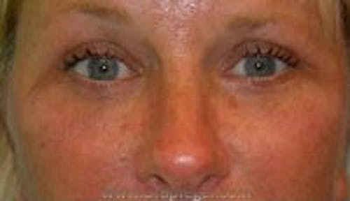 Blepharoplasty Before & After Gallery - Patient 608553 - Image 2