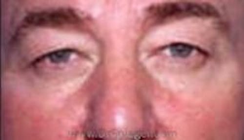 Blepharoplasty Before & After Gallery - Patient 371948 - Image 1