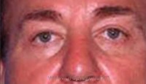 Blepharoplasty Before & After Gallery - Patient 371948 - Image 2