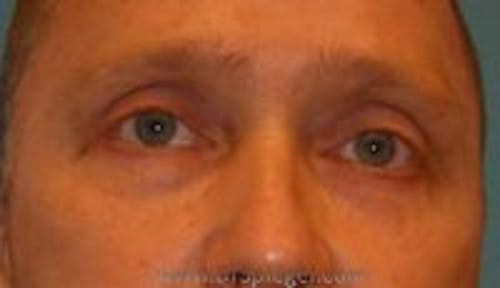 Blepharoplasty Before & After Gallery - Patient 124286 - Image 2