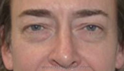 Blepharoplasty Before & After Gallery - Patient 159259 - Image 1