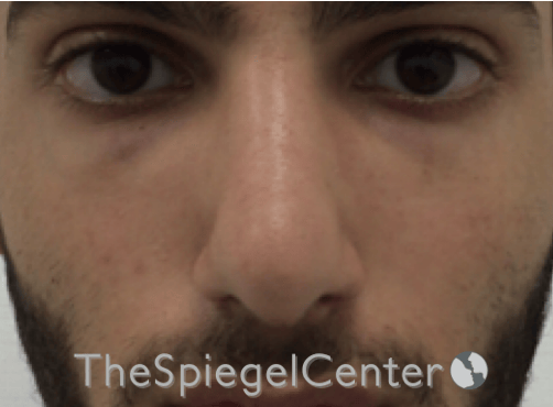 Rhinoplasty Before & After Gallery - Patient 228833 - Image 4