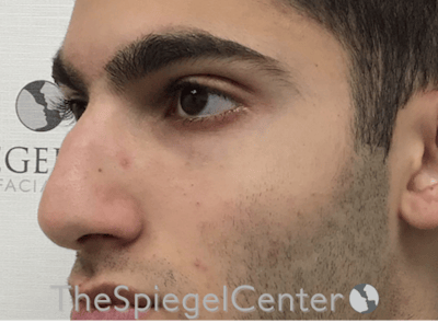 Rhinoplasty Before & After Gallery - Patient 228833 - Image 1