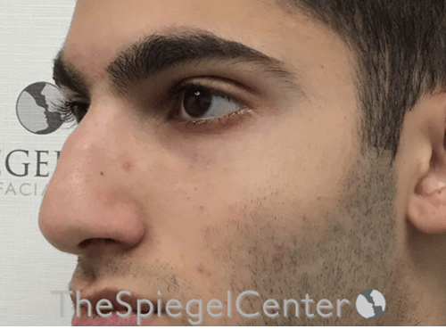 Rhinoplasty Before & After Gallery - Patient 228833 - Image 1