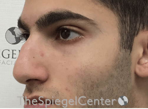Rhinoplasty Before & After Gallery - Patient 228833 - Image 1