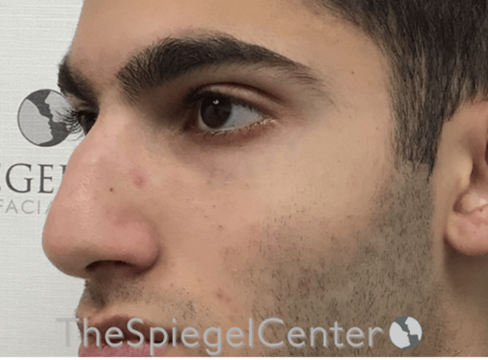 Rhinoplasty
