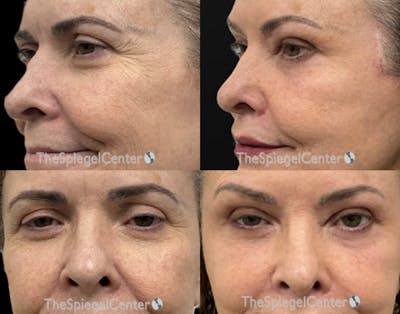 Rhinoplasty Before & After Gallery - Patient 258341 - Image 1