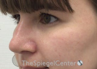 Rhinoplasty Before & After Gallery - Patient 294095 - Image 2