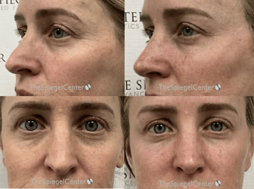 Rhinoplasty Before & After Gallery - Patient 398008 - Image 1