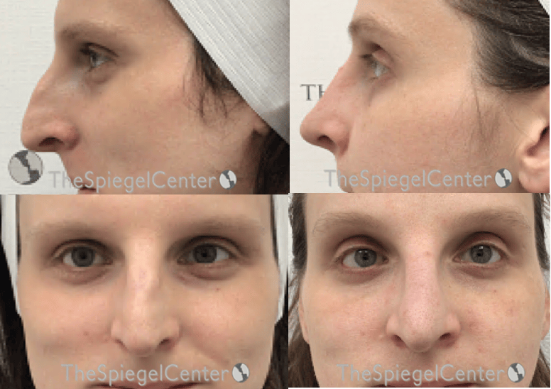 Rhinoplasty Before & After Gallery - Patient 190896 - Image 1
