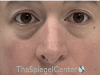 Rhinoplasty Before & After Gallery - Patient 125798 - Image 3