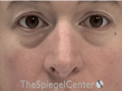 Rhinoplasty Before & After Gallery - Patient 125798 - Image 3