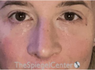 Rhinoplasty Before & After Gallery - Patient 125798 - Image 4