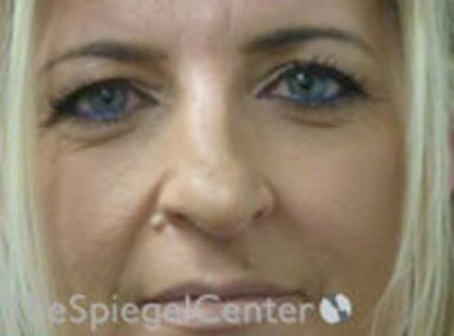Rhinoplasty Before & After Gallery - Patient 315874 - Image 3