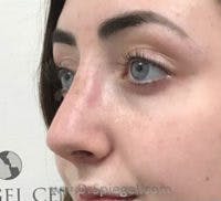 Rhinoplasty Before & After Gallery - Patient 617680 - Image 2