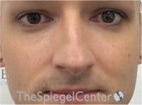 Rhinoplasty Before & After Gallery - Patient 217779 - Image 3