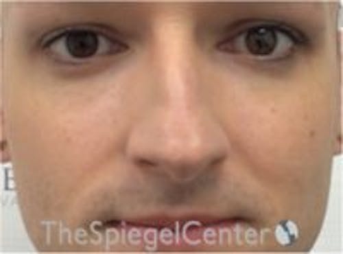 Rhinoplasty Before & After Gallery - Patient 217779 - Image 3