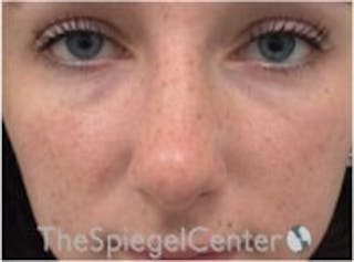 Rhinoplasty Before & After Gallery - Patient 101205 - Image 4
