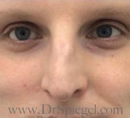 Rhinoplasty Before & After Gallery - Patient 155125 - Image 3