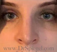 Rhinoplasty Before & After Gallery - Patient 155125 - Image 4