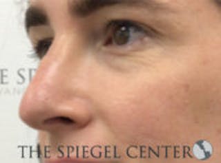 Rhinoplasty Before & After Gallery - Patient 198047 - Image 2