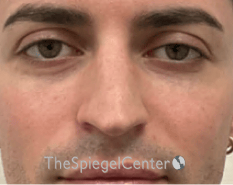 Rhinoplasty Before & After Gallery - Patient 233036 - Image 3
