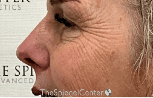 Cheek Implants Before & After Gallery - Patient 415787 - Image 3
