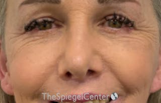 Cheek Implants Before & After Gallery - Patient 415787 - Image 2