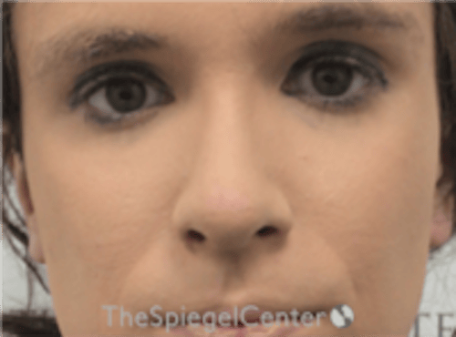 Rhinoplasty Before & After Gallery - Patient 380334 - Image 4