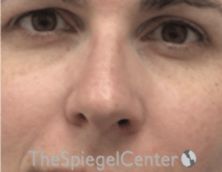Rhinoplasty Before & After Gallery - Patient 134951 - Image 3
