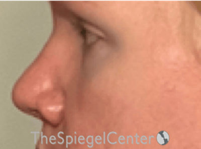 Rhinoplasty Before & After Gallery - Patient 287243 - Image 1