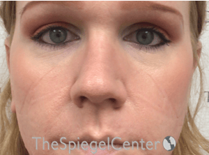 Rhinoplasty Before & After Gallery - Patient 287243 - Image 4