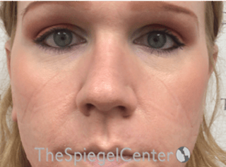Rhinoplasty Before & After Gallery - Patient 287243 - Image 4
