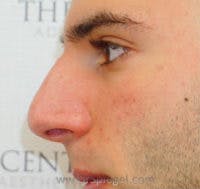 Rhinoplasty Before & After Gallery - Patient 318096 - Image 1