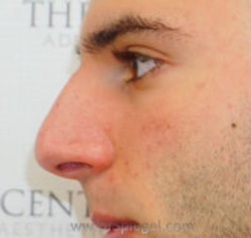Rhinoplasty Before & After Gallery - Patient 318096 - Image 1