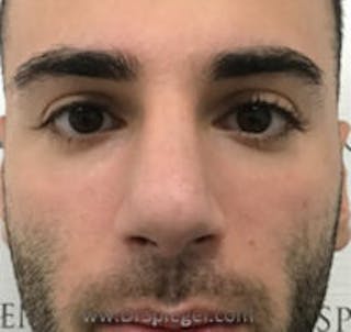 Rhinoplasty Before & After Gallery - Patient 318096 - Image 4