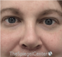 Rhinoplasty Before & After Gallery - Patient 168077 - Image 4