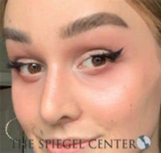 Rhinoplasty Before & After Gallery - Patient 103875 - Image 2