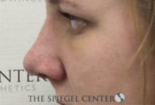 Rhinoplasty Before & After Gallery - Patient 402729 - Image 2