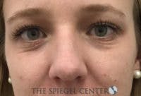 Rhinoplasty Before & After Gallery - Patient 402729 - Image 3