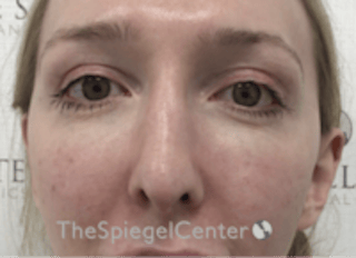 Rhinoplasty Before & After Gallery - Patient 429228 - Image 4