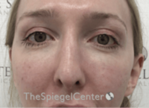 Rhinoplasty Before & After Gallery - Patient 429228 - Image 4