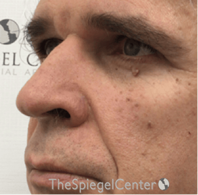 Rhinoplasty Before & After Gallery - Patient 143051 - Image 1