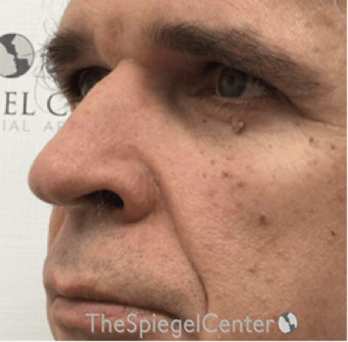 Rhinoplasty Before & After Gallery - Patient 143051 - Image 1