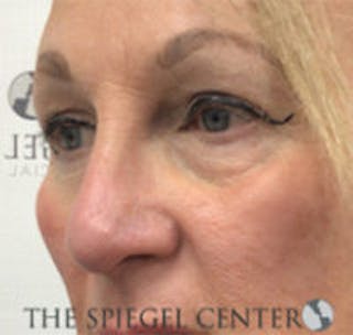 Rhinoplasty Before & After Gallery - Patient 318881 - Image 2