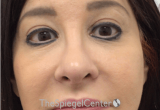 Rhinoplasty Before & After Gallery - Patient 132206 - Image 4
