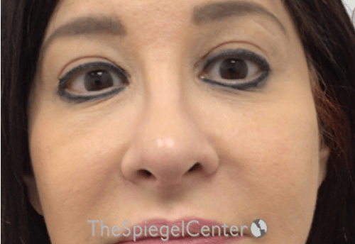 Rhinoplasty Before & After Gallery - Patient 132206 - Image 4
