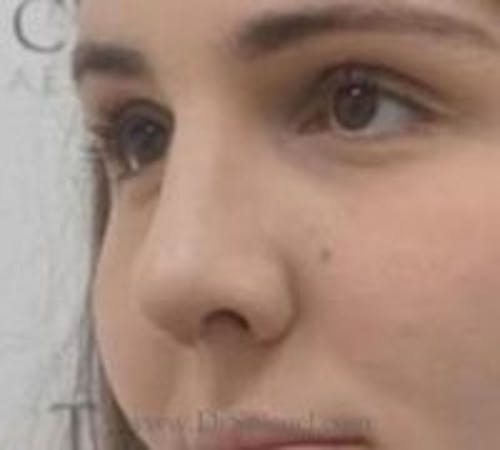 Rhinoplasty Before & After Gallery - Patient 430464 - Image 2