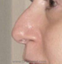 Rhinoplasty Before & After Gallery - Patient 387905 - Image 1